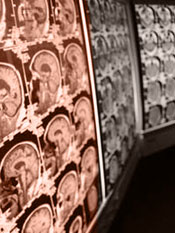 Traumatic Brain Injury